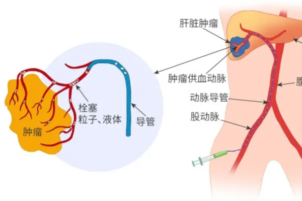 战胜肝癌的十大法宝（上）